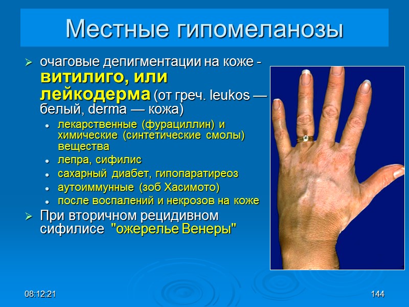 08:12:02 144 Местные гипомеланозы очаговые депигментации на коже - витилиго, или лейкодерма (от греч.